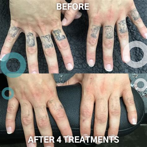 removery tattoo removal & fading|removery tattoo removal pricing.